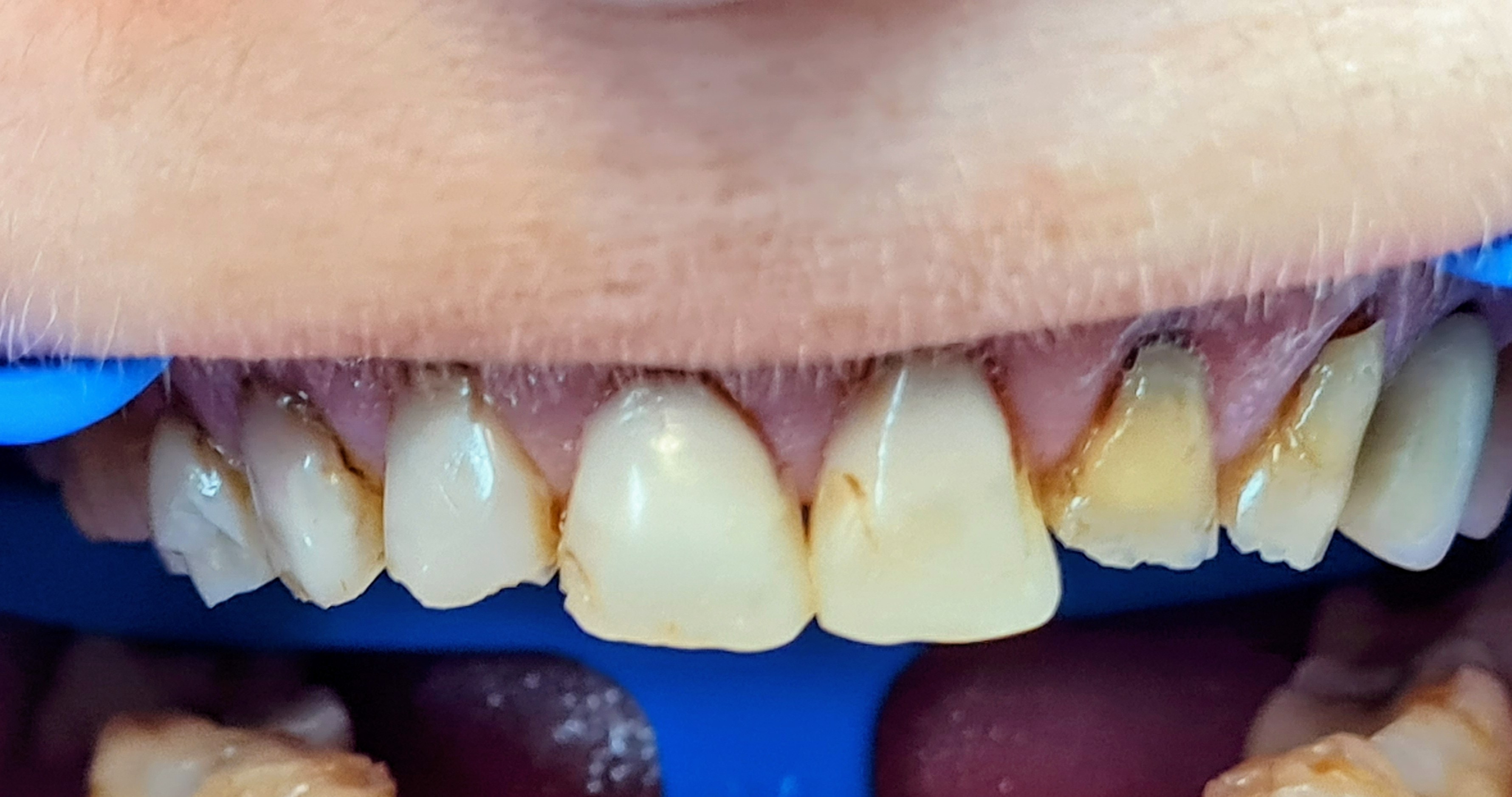 Zâmbet înainte de aplicarea coroanelor ceramo-metalice