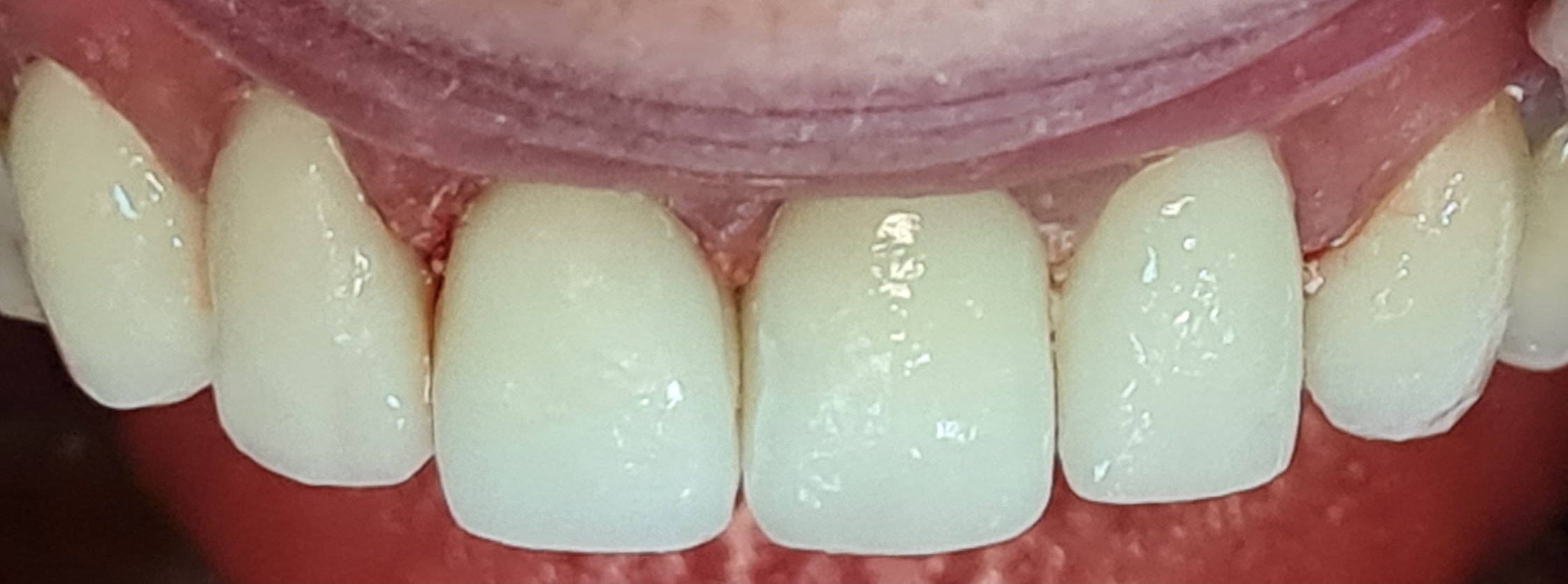 Zâmbet după aplicarea coroanelor ceramo-metalice