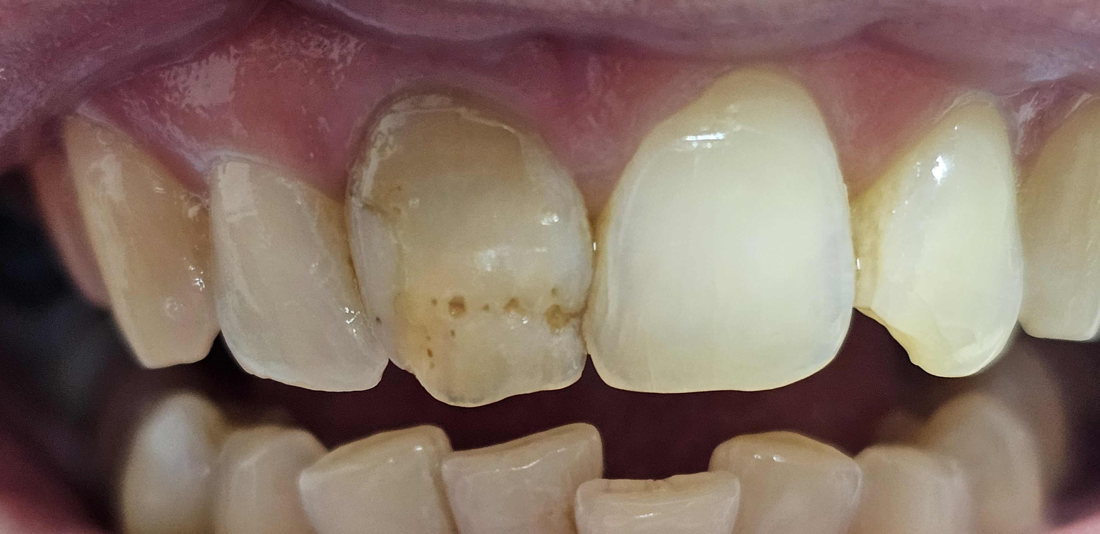 Zâmbet înainte de aplicarea coroanelor metalo-ceramice