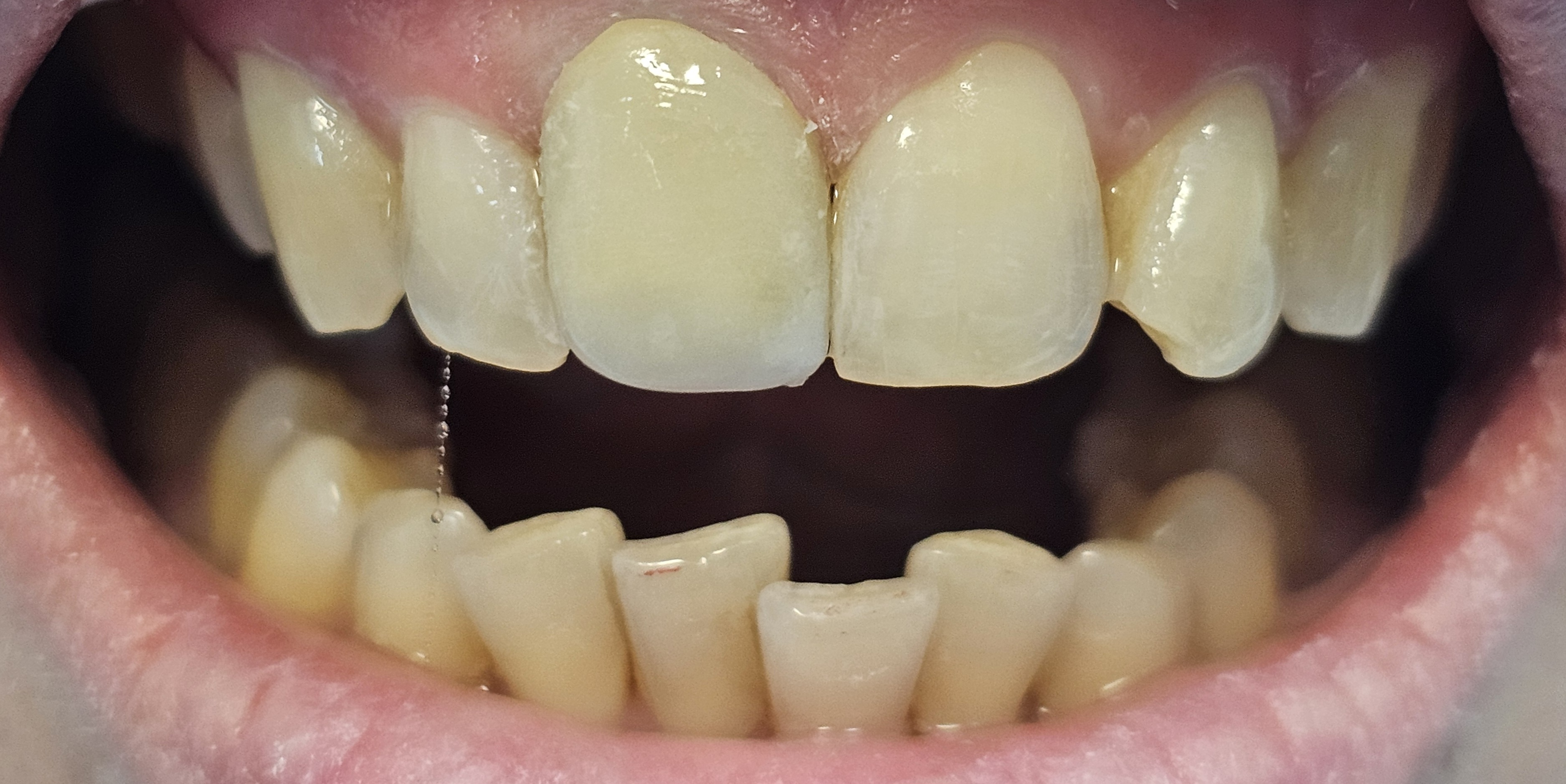 Zâmbet după aplicarea coroanelor metalo-ceramice