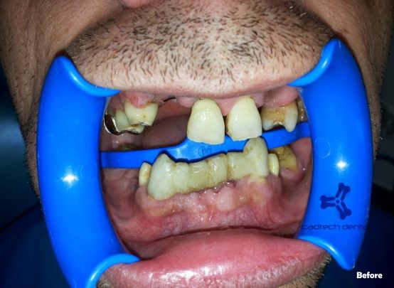 Zâmbet înainte de reabilitare orală totală
