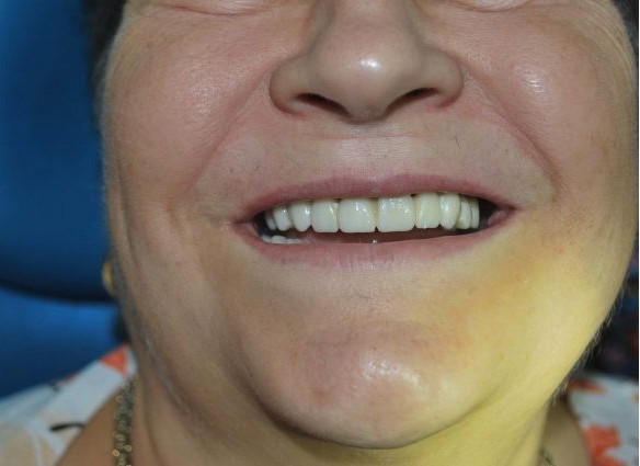 Zâmbet după reabilitare totală cu punte pe implanturi